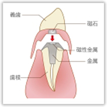 保険総入れ歯