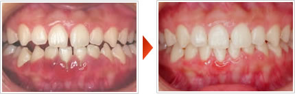 歯肉炎例